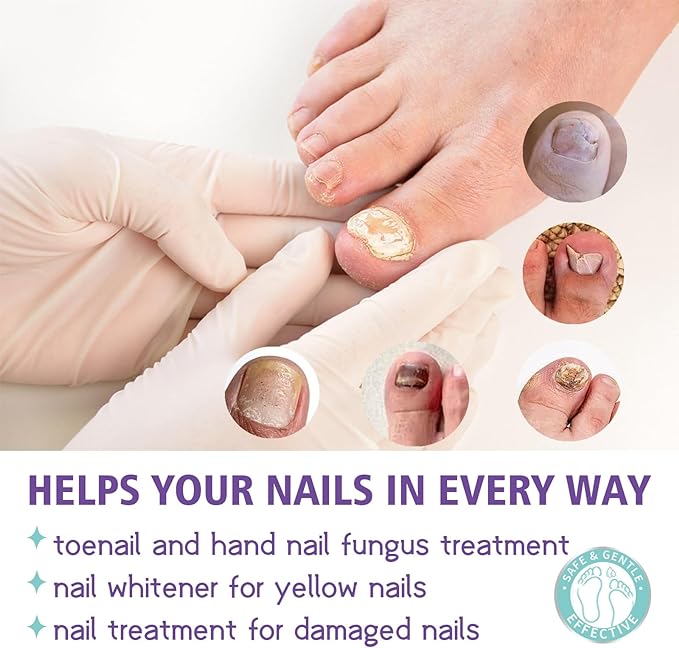 Nail Fungus Treatment Spray – Powerful Solution for Healthy Hands & Feet
