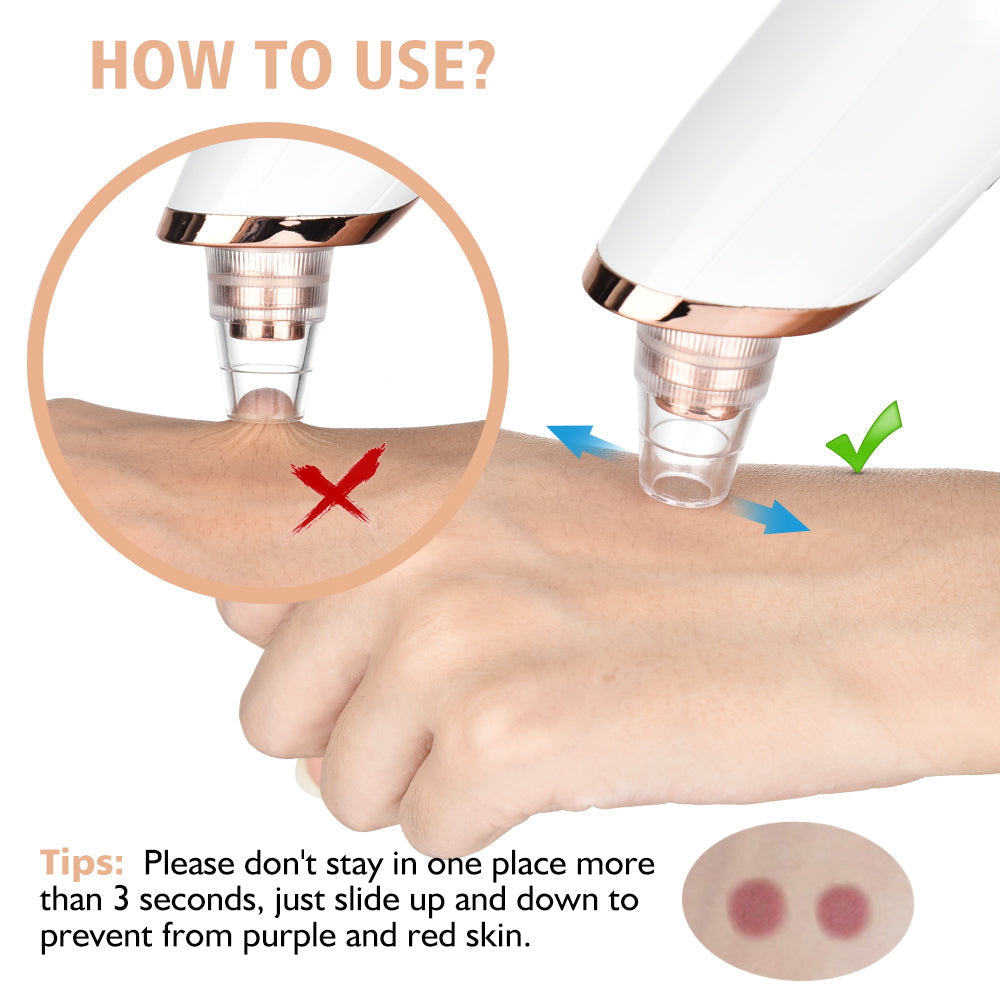Pore Vacuum Blackhead Remover – Deep Cleansing Tool